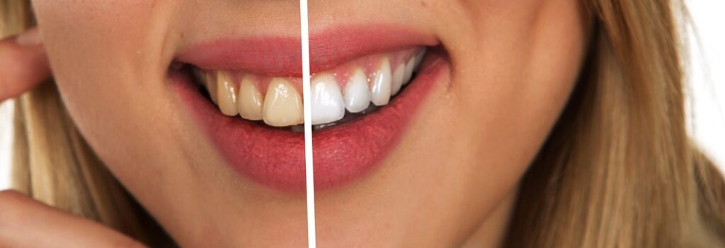 Professional teeth whitening