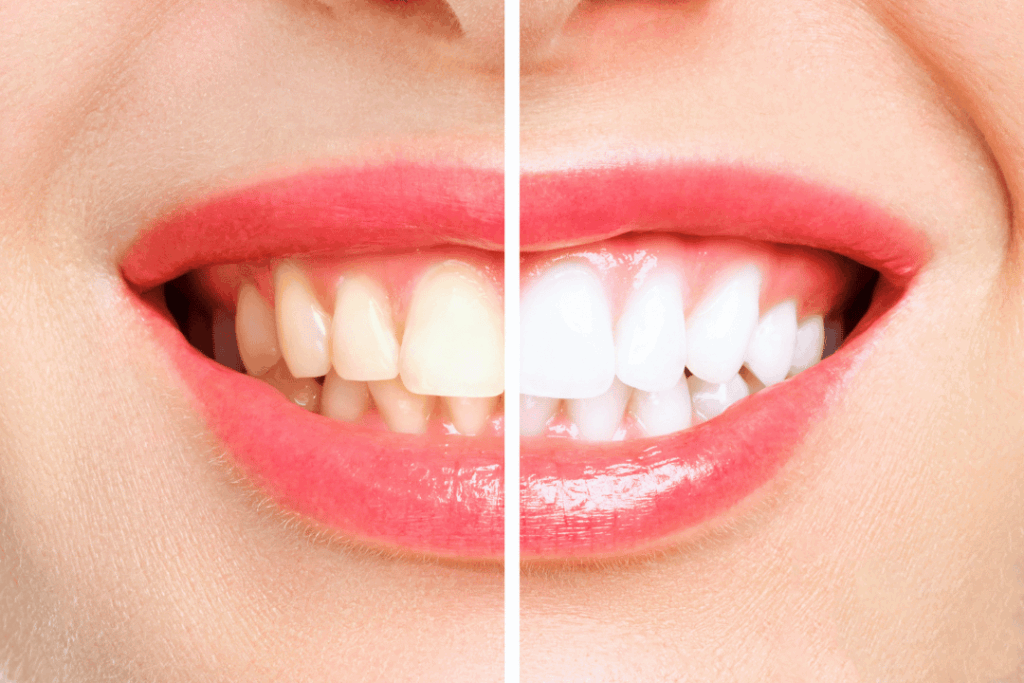 before and after teeth whitening
