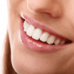 bright white smile after teeth whitening