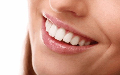 bright white smile after teeth whitening