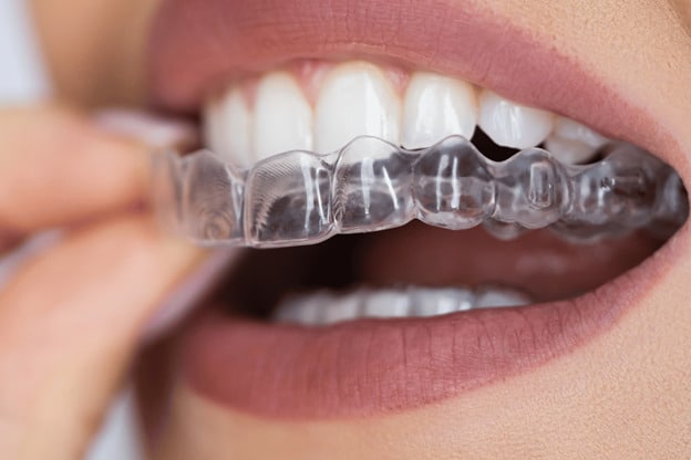 before and after ClearCorrect smile
